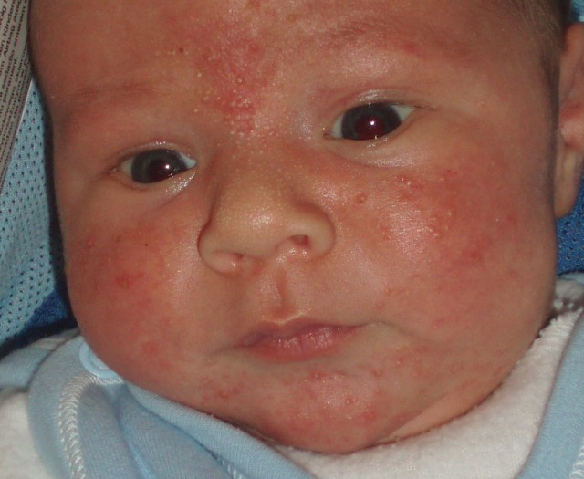пищевая аллергия у ребенка
