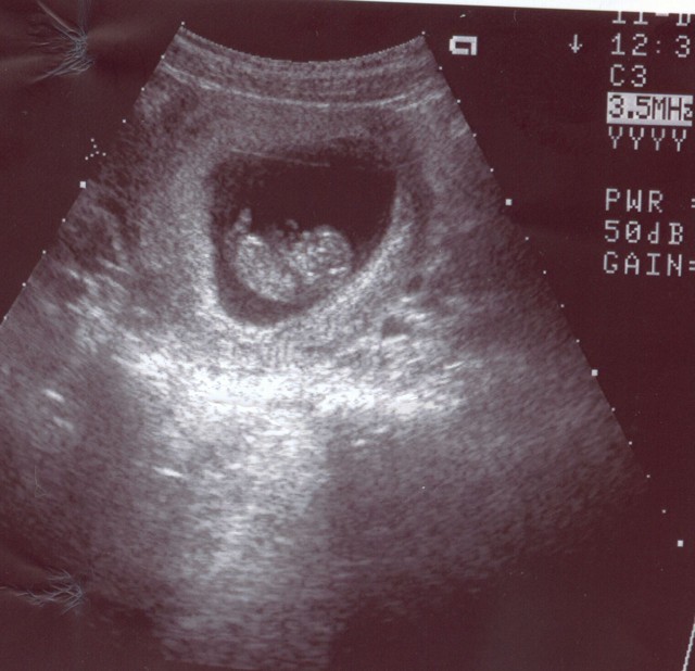 8 недели задержки. Снимки УЗИ на 8 неделе беременности. Снимок УЗИ на 7-8 неделе беременности. Снимок УЗИ на 8 неделе беременности. 8 Недель беременности фото плода на УЗИ.