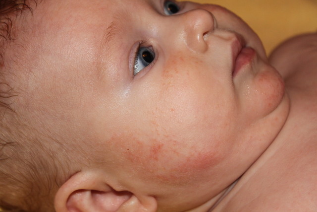 Сыпь на левой щеке у ребенка thumbnail