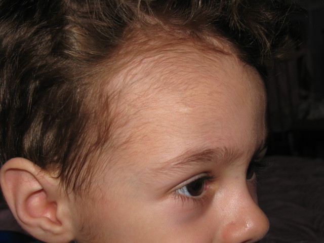 У ребенка выпирает лоб. Волосы на лбу у новорожденного.