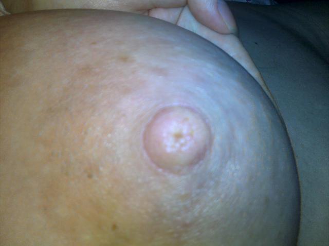 Воспаление на соске форум thumbnail