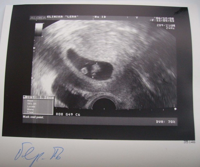 Узи срок 3 недели. Снимок УЗИ на 4 неделе беременности двойней. УЗИ 2-3 недели беременности двойня. УЗИ 8.5 недель беременности. УЗИ 3 недели беременности двойня.